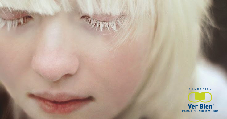El albinismo y los problemas visuales